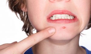 El acné en los adultos: causas y tratamientos